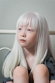 Image result for Albino People Girls