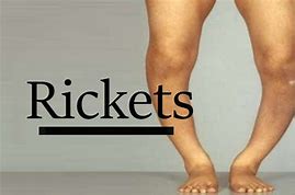 Image result for Rickets vs Normal