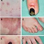 Image result for Autoimmune Disease Skin Rash