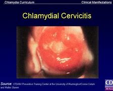 Image result for Chlamydia Skin Lesions