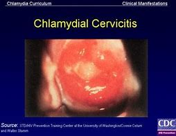 Image result for Acute Genital Ulcers