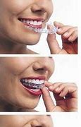 Image result for Invisible Braces for Kids