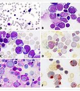 Image result for Pure Erythroid Leukemia