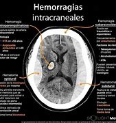 Image result for hemorragis