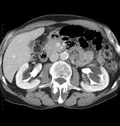 Image result for Renal Sinus Cyst