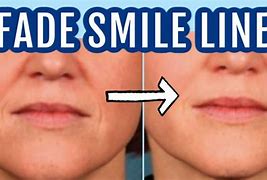 Image result for Vertical Smile vs Horizontal