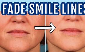 Image result for Male Smile Lines
