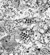 Image result for Molluscum Contagiosum Virus