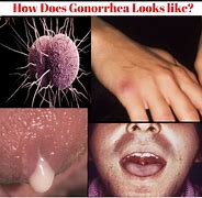 Image result for Cutaneous Gonorrhea