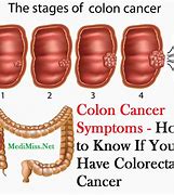 Image result for 6 Centimeters Tumor in Colon