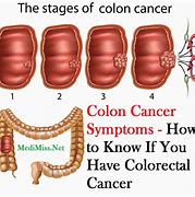 Image result for 10 Cm Tumor in Colon