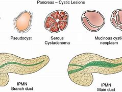 Image result for Pancreatic Intraductal