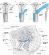 Image result for Cervical Cancer