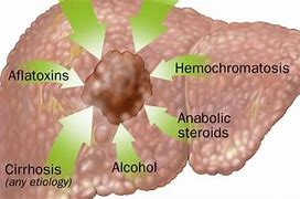 Image result for hemocromatisis