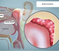 Image result for adenoso