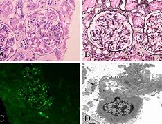 Image result for IgA Nephropathy Histology