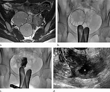 Image result for Treatment for Ovarian Cyst