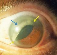 Image result for Repositioning Intraocular Lens