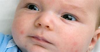 Image result for Babies with Pimples