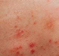 Image result for Genital Pimples On Women