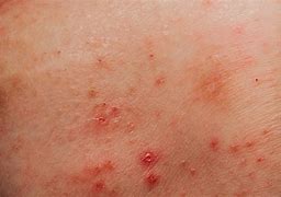 Image result for Genital Warts and HIV
