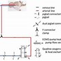 Image result for Avalon Catheter ECMO