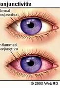 Image result for Conjunctivitis Pink Eye Symptoms