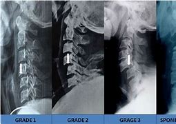 Image result for Anterior Subluxation Cervical Spine