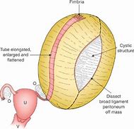 Image result for Right Adnexal Cyst