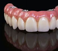 Image result for All On 4 Dental Implants