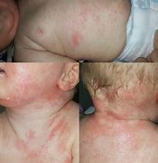 Image result for Eczema 2 Year Old
