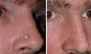 Image result for Wart On Nose
