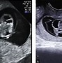 Image result for Exencephaly Fetal Ultrasound