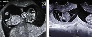 Image result for Anencephaly in Ultrasound