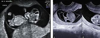 Image result for Anencephaly Fetal Ultrasound