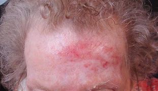 Image result for dermatosis