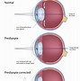 Image result for Cataract Premium Lens