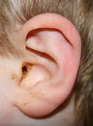 Image result for Hearing Aid OTC D. Rowell Ear