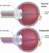 Image result for Astigmatism Lenses
