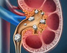 Image result for 7Mm Kidney Stone in Ureter Treat Men