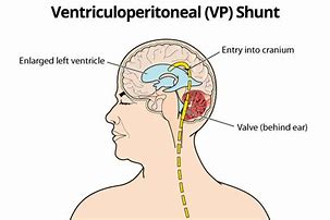 Image result for Hydrocephalus Shunt Placement