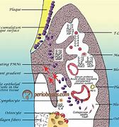Image result for Gingival and Periodontal Pocket