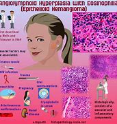 Image result for Chlamydia Lesions