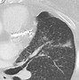 Image result for Granuloma Lung Nodule