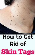 Image result for Warts On Neck Area