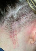 Image result for Brain Tumor Surgery Scar