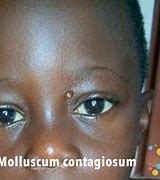 Image result for Molluscum Contagiosum Black Skin