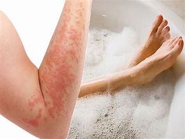 Image result for Weeping Eczema