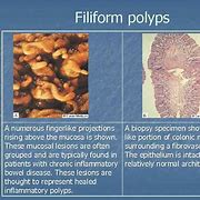 Image result for Filiform Polyp