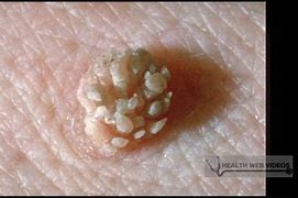 Image result for Warts On Genital Area
